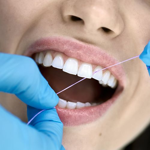 Dental hygienist flossing patient's teeth