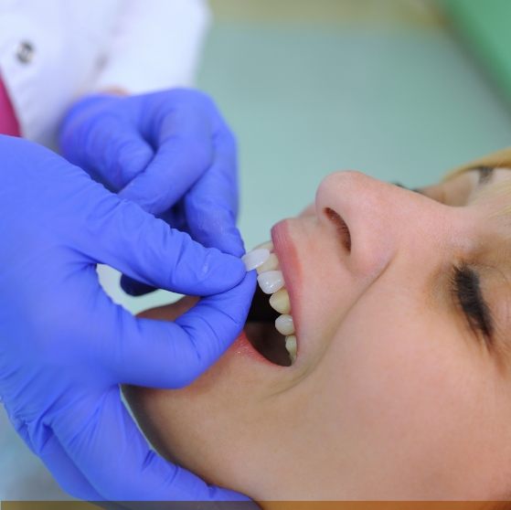 Stone Mountain cosmetic dentist placing a veneer on a patients front tooth