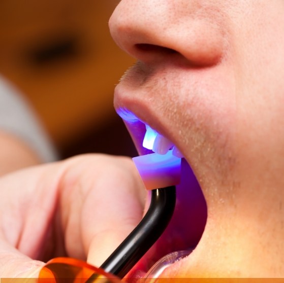 Close up of dental patient getting direct bonding on an upper front tooth