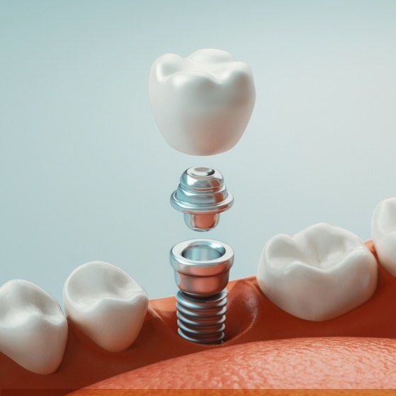 Illustrated dental implant being placed in the lower jaw