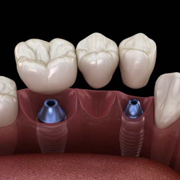 Illustrated dental bridge being placed onto two dental implants