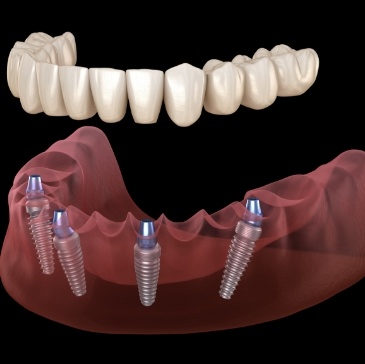 Illustrated full denture being placed onto four dental implants