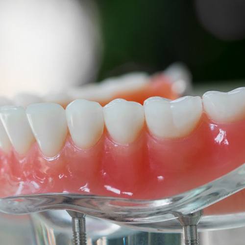 Denture sitting on a clear display stand with dental implants