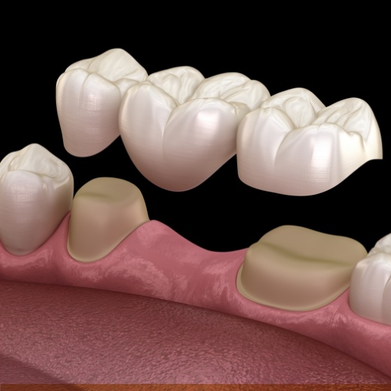 Illustrated dental bridge replacing a missing tooth