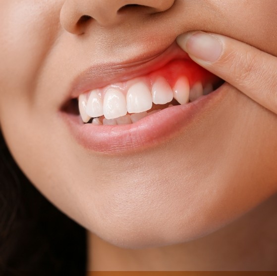 Close up of person pointing to a red spot in their gums