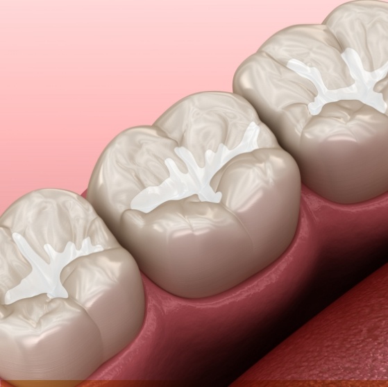 Illustrated row of teeth with dental sealants