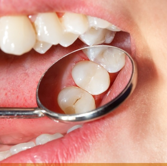 Close up of dental mirror inside of mouth