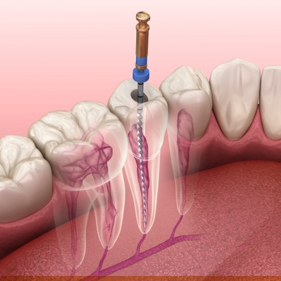 Illustrated dental instrument cleaning inside a tooth during root canal treatment