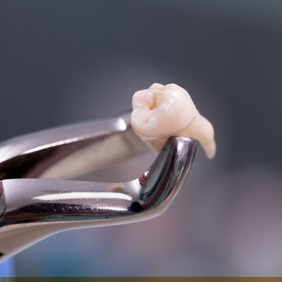 Dental forceps holding an extracted tooth