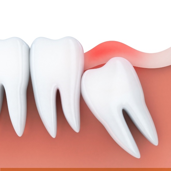 Illustrated impacted wisdom tooth pressing against molar