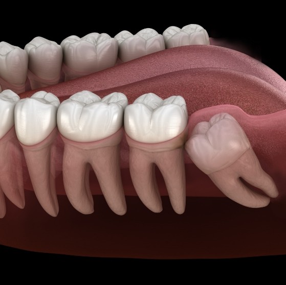 Illustration of a wisdom tooth pushing against back molar