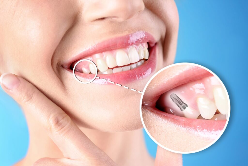 Nose-to-neck view of woman smiling with finger on cheek with one tooth indicated as implant