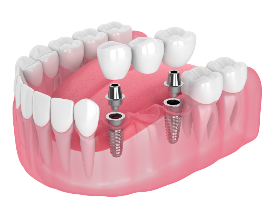 Illustration of dental implant