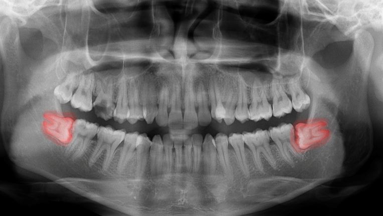An X-ray of impacted wisdom teeth