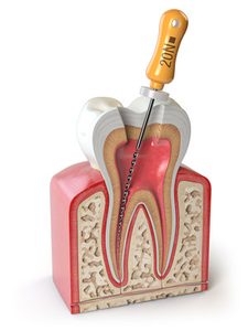 Illustration of a root canal treatment